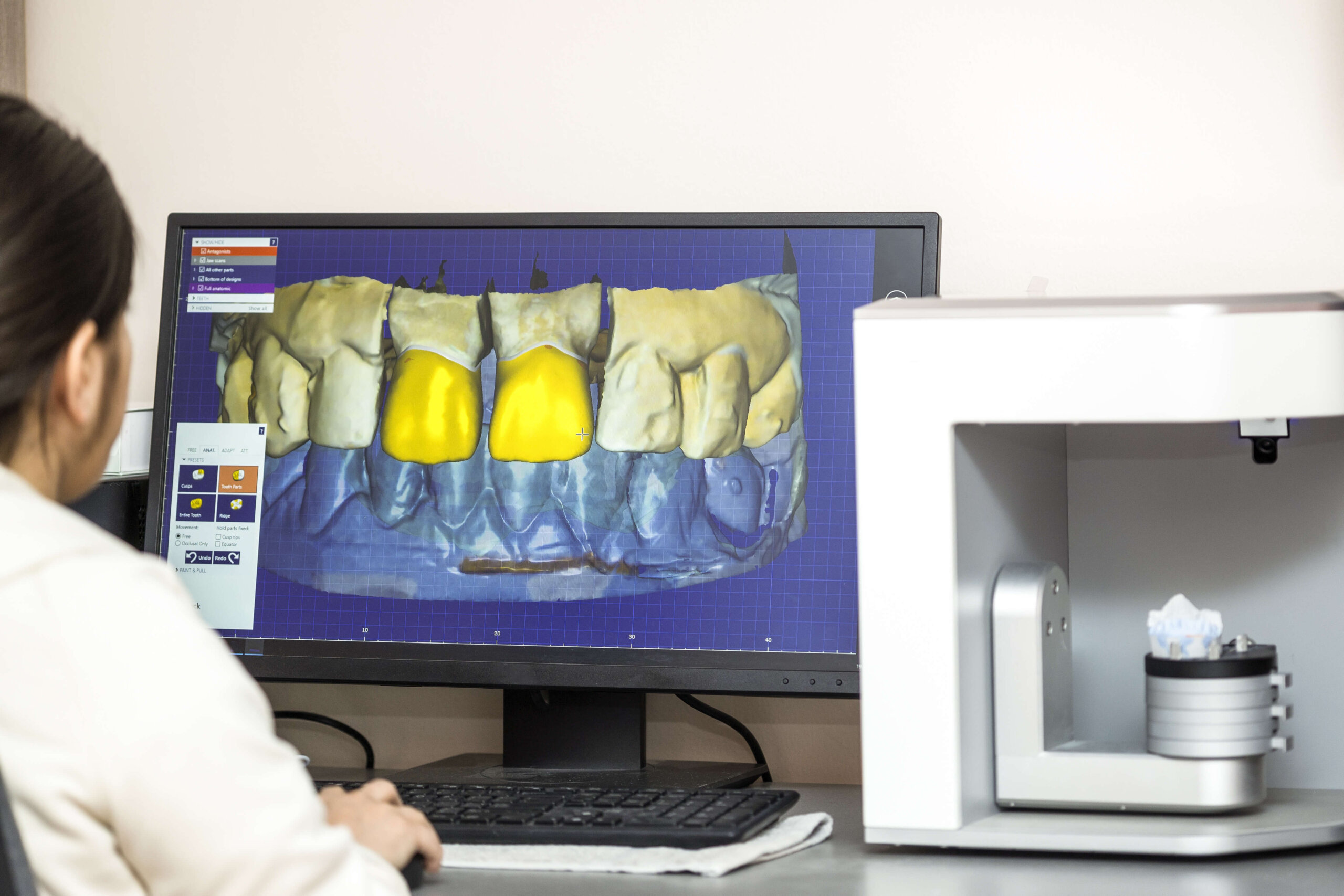 Digital scanning is also known as 3-D intraoral scanning