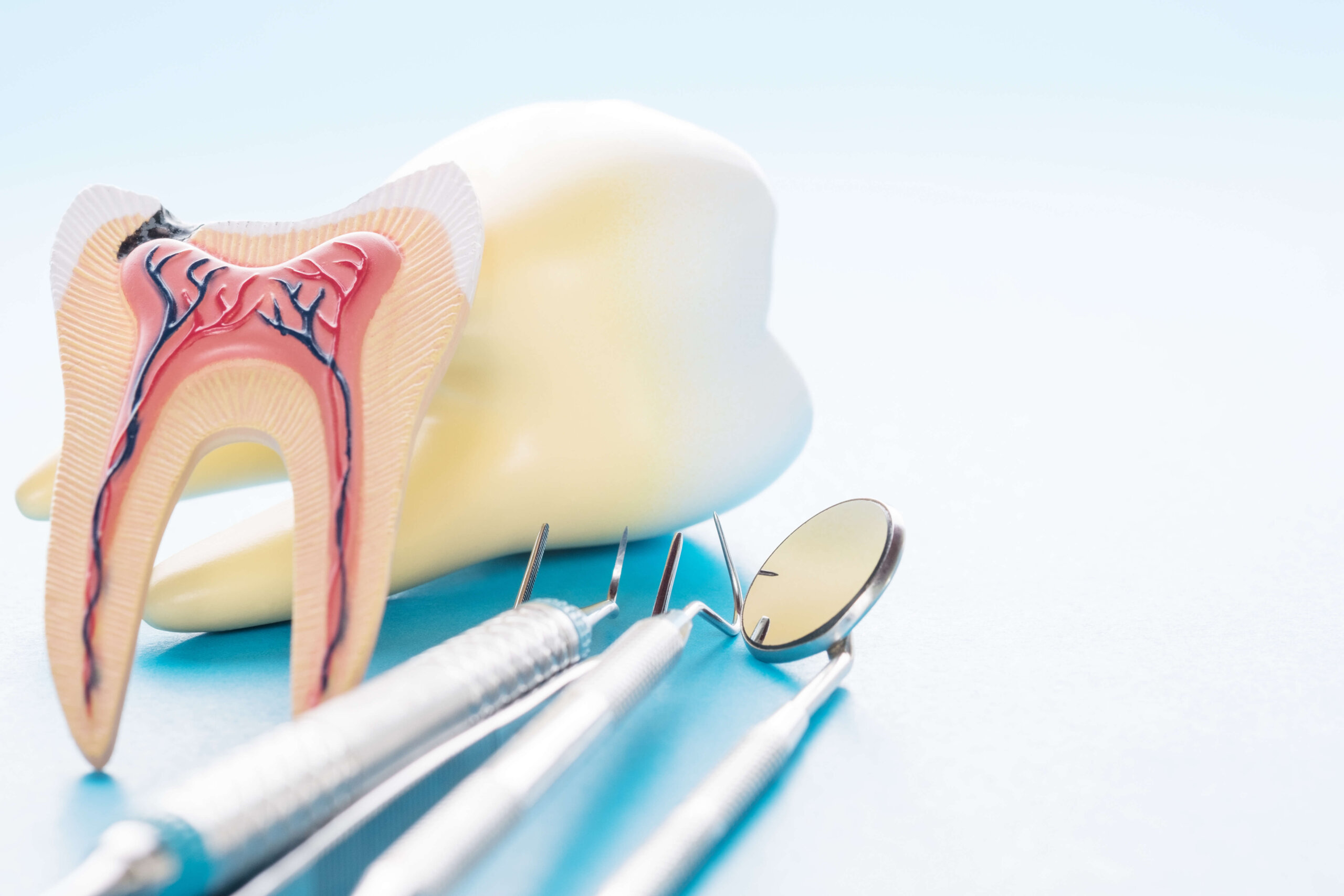 Root Canals may be necessary when a tooth is severely cracked and becomes infected.