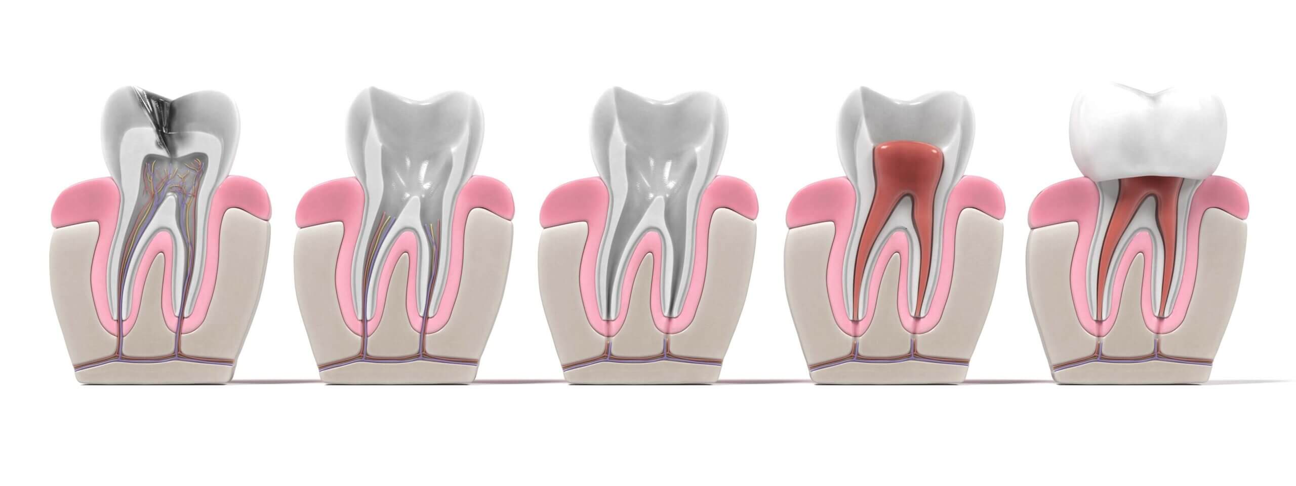Root Canal Images for Dr. Rich Higgs in Chandler AZ