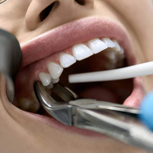 Tooth Extractions at Aquila Dental Chandler AZ
