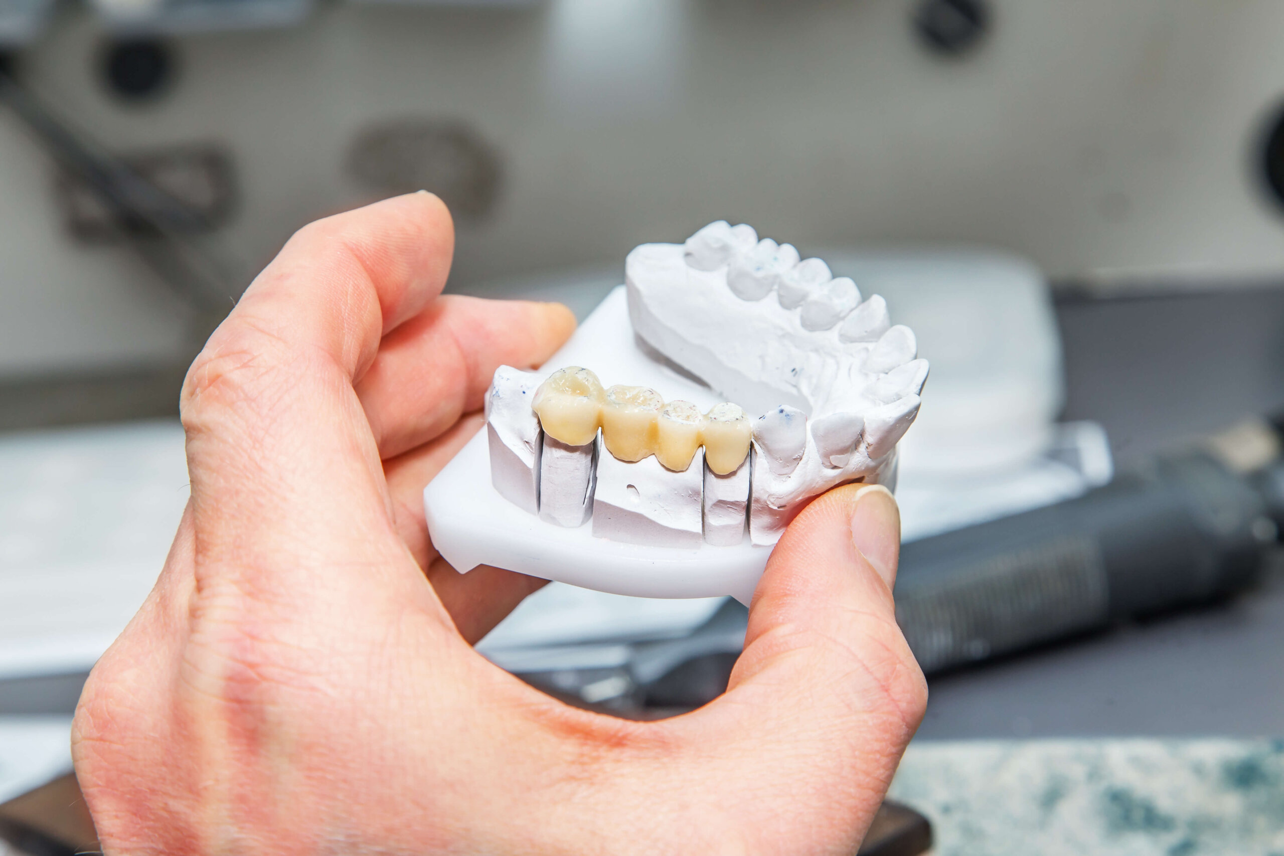 Dental Implants and Bridges at Aquila Dental