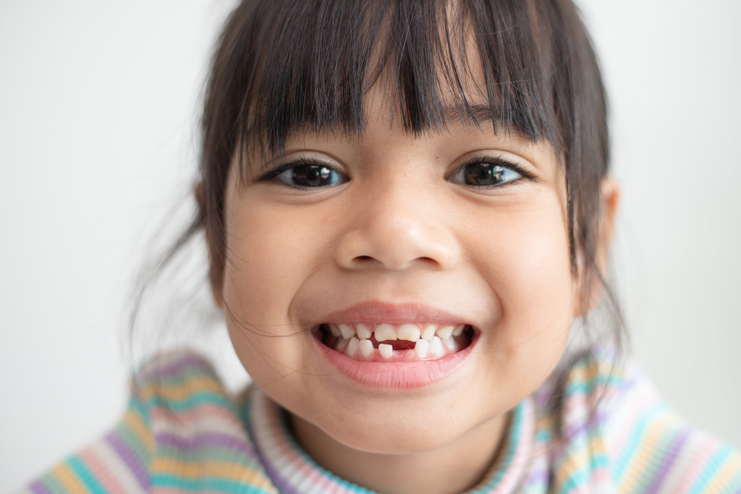Little girl Tooth Decay - Pulpotomy Treatment