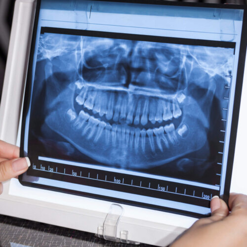 Dental X Rays at Aquila Dental Chandler AZ