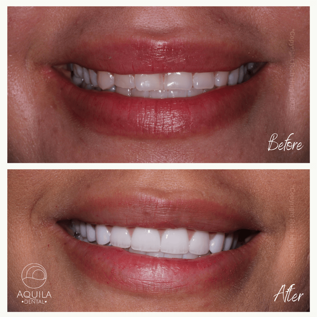 Before and after dental restoration (veneers) by Dr. Rich Higgs at Aquila Dental in Chandler, Arizona