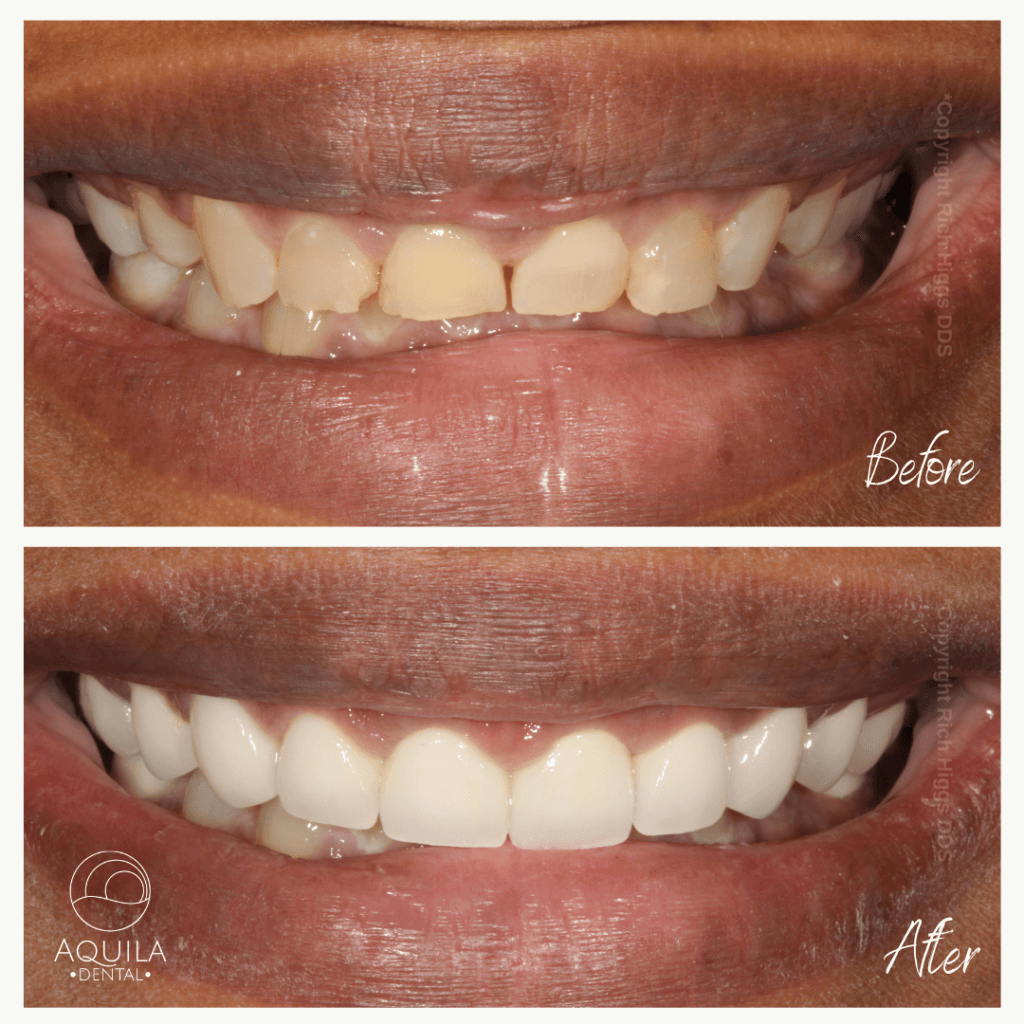 Before and after dental restoration with Porcelain veneers by Dr. Rich Higgs at Aquila Dental in Chandler, Arizona