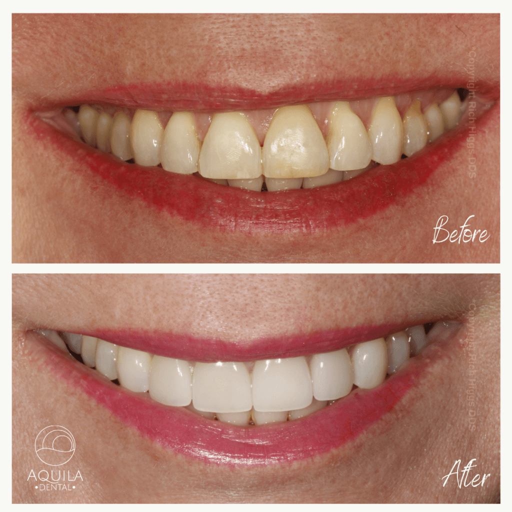 Before and after dental restoration (veneers) by Dr. Rich Higgs at Aquila Dental in Chandler, Arizona