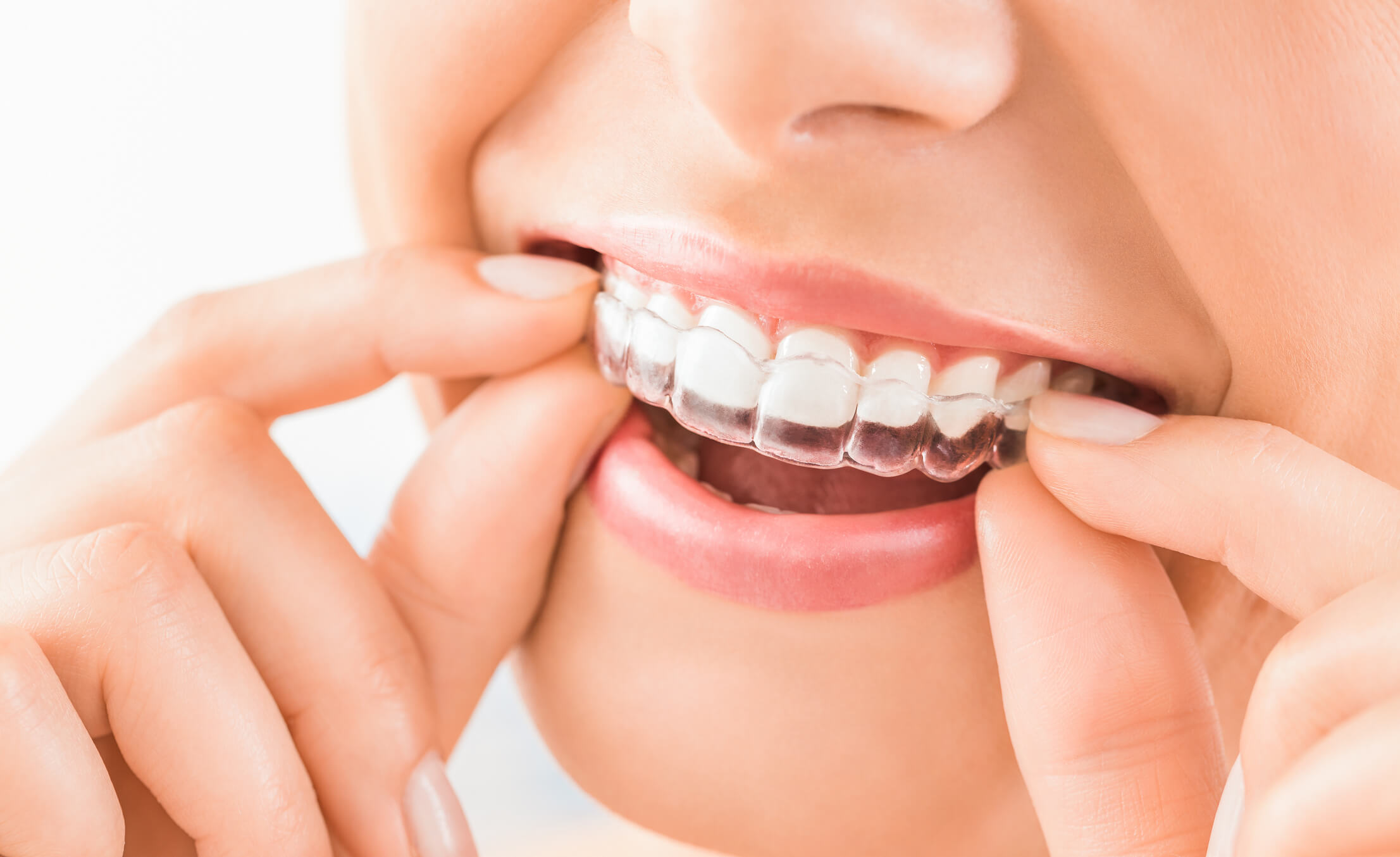 Transform your smile with Invisalign at Aquila Dental Chandler AZ