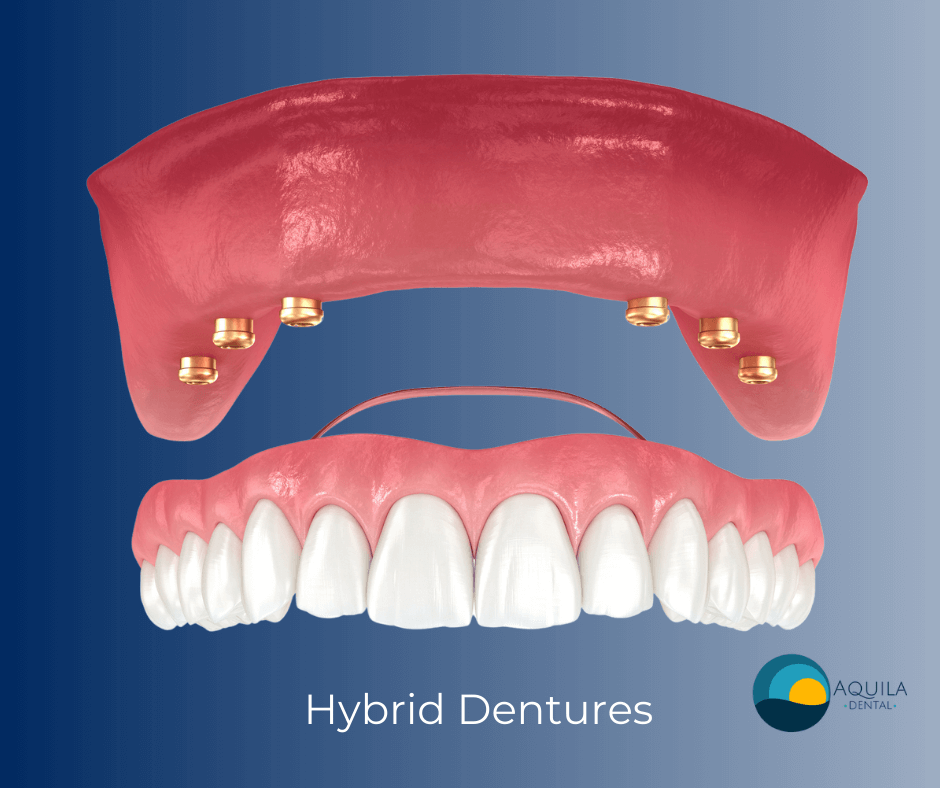 Hybrid dentures at Aquila Dental