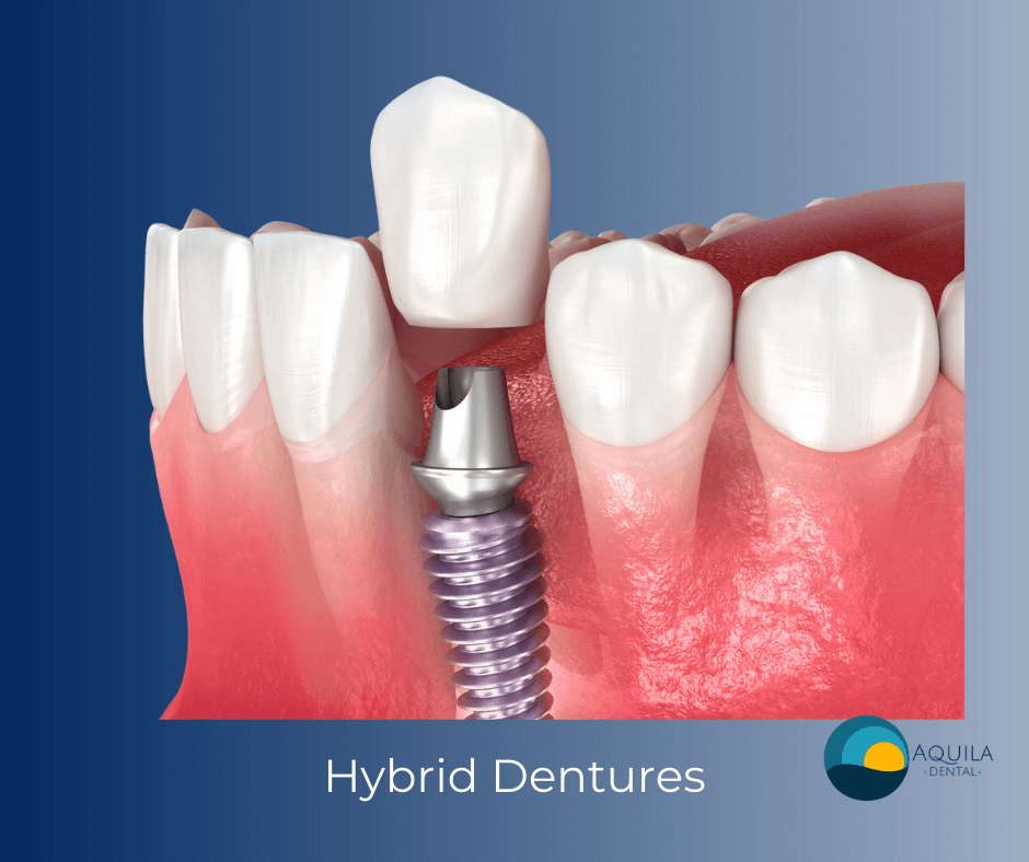 Revamp your smile with Hybrid Dentures at Aquila Dental