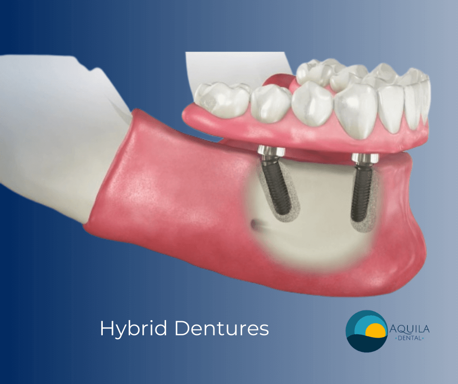 Hybrid Dentures at Aquila Dental